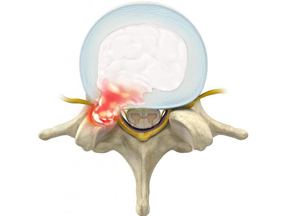 un disque endommagé provoque des maux de dos