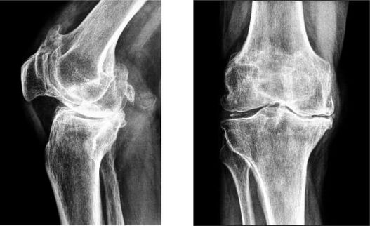 Gonarthrose du genou sur radiographie