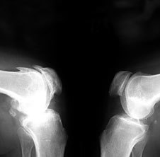 L'Arthrose sur la Radiographie