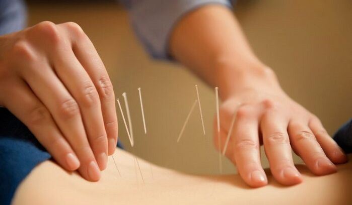 acupuncture pour traiter les douleurs lombaires