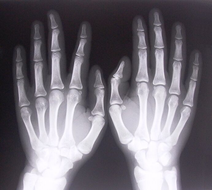 La radiographie comme moyen de diagnostiquer la douleur dans les articulations des doigts. 