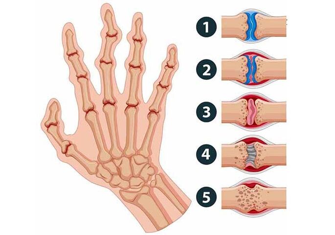 stades de développement de l'arthrite des articulations des doigts. 